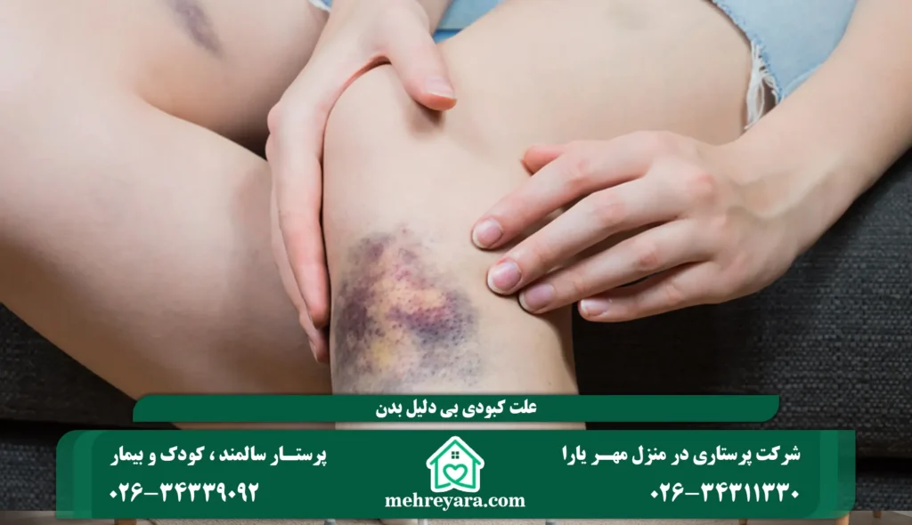 علت کبودی بی دلیل بدن