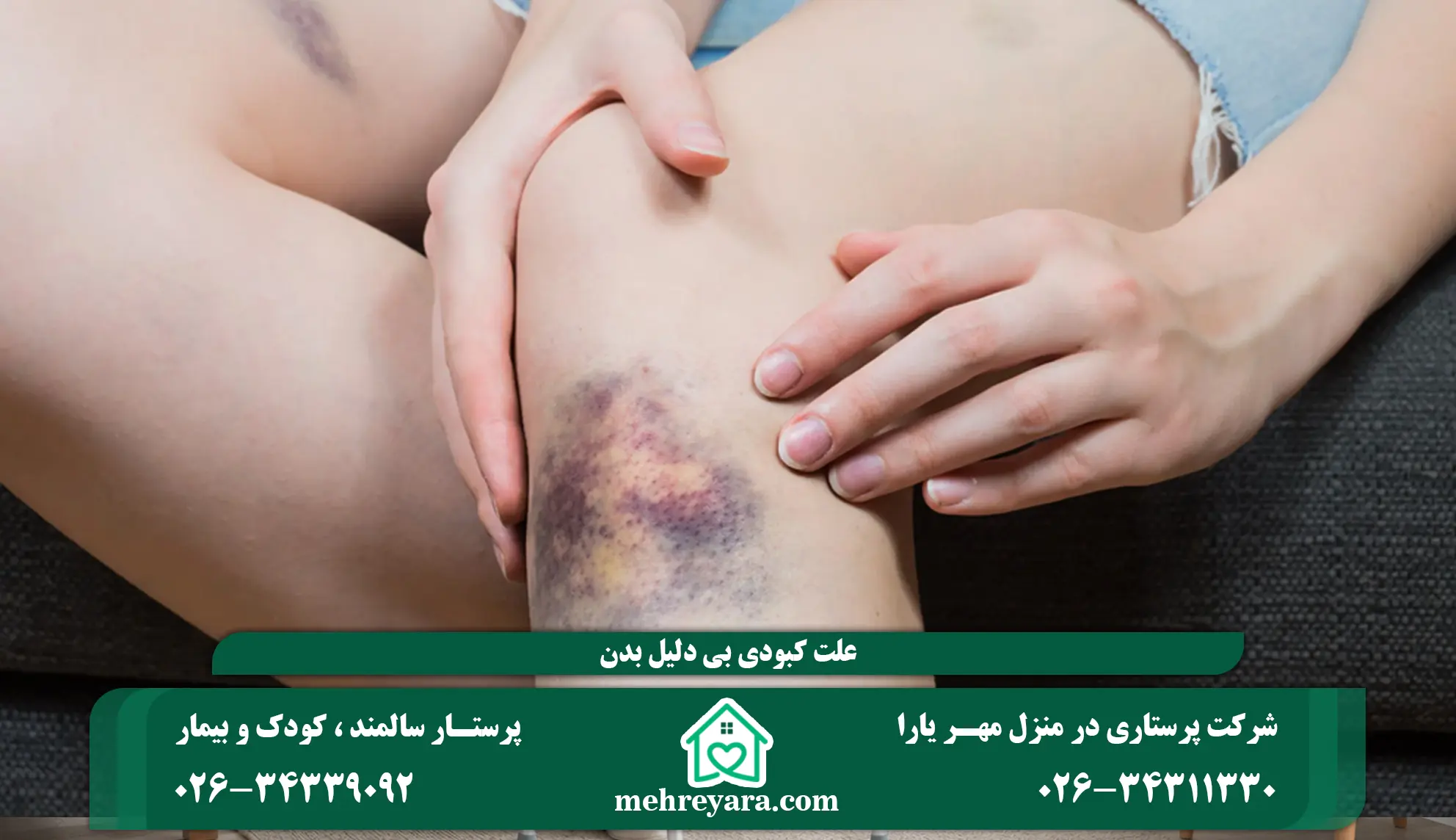 علت کبودی بی دلیل بدن