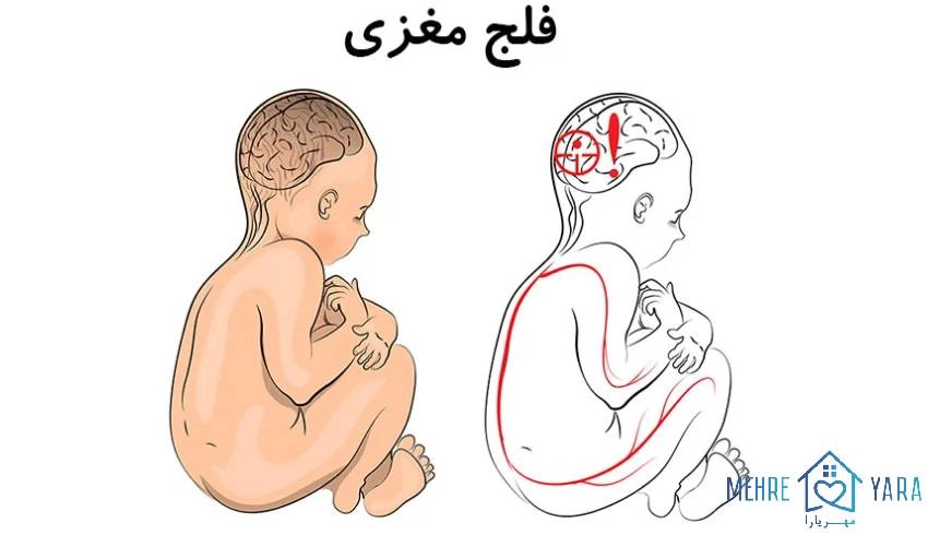 فلج مغزی چیست